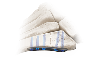 5ms plantar plate