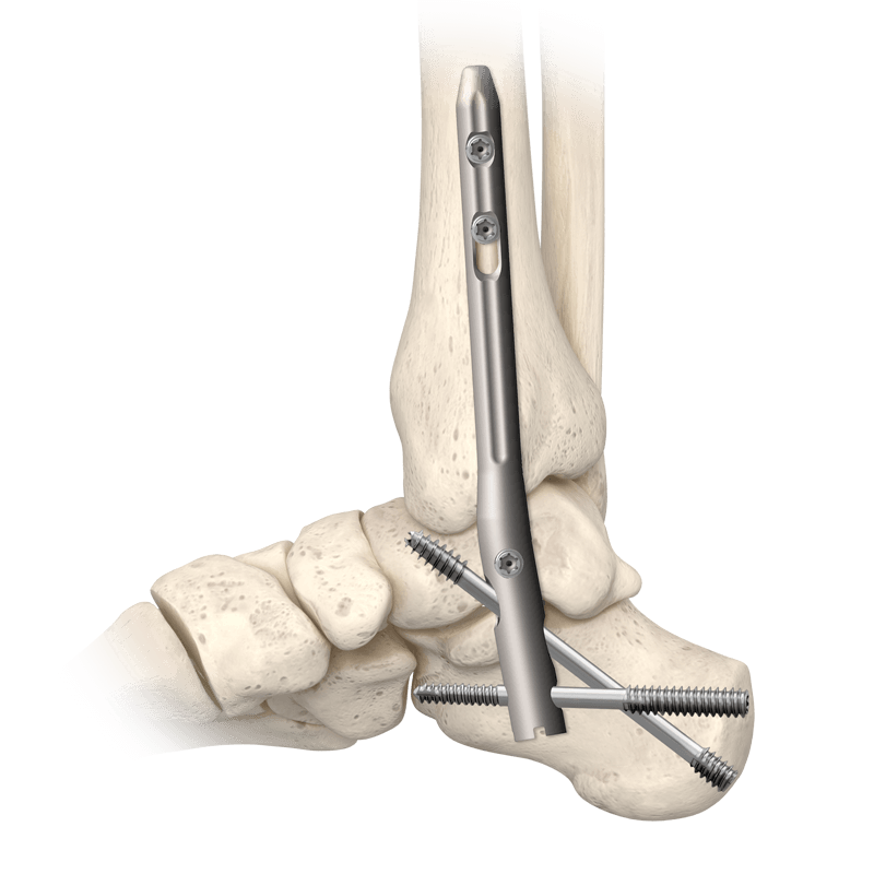 animation of triway fusion nail in the bone