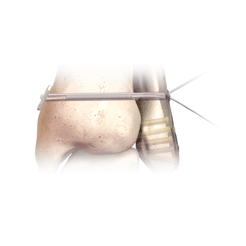 Hercules<sup>®</sup> Knotless Syndesmosis Implant System
