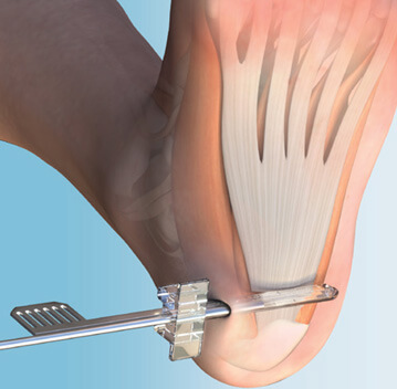ClearGuard LE Plantar Fascia Release