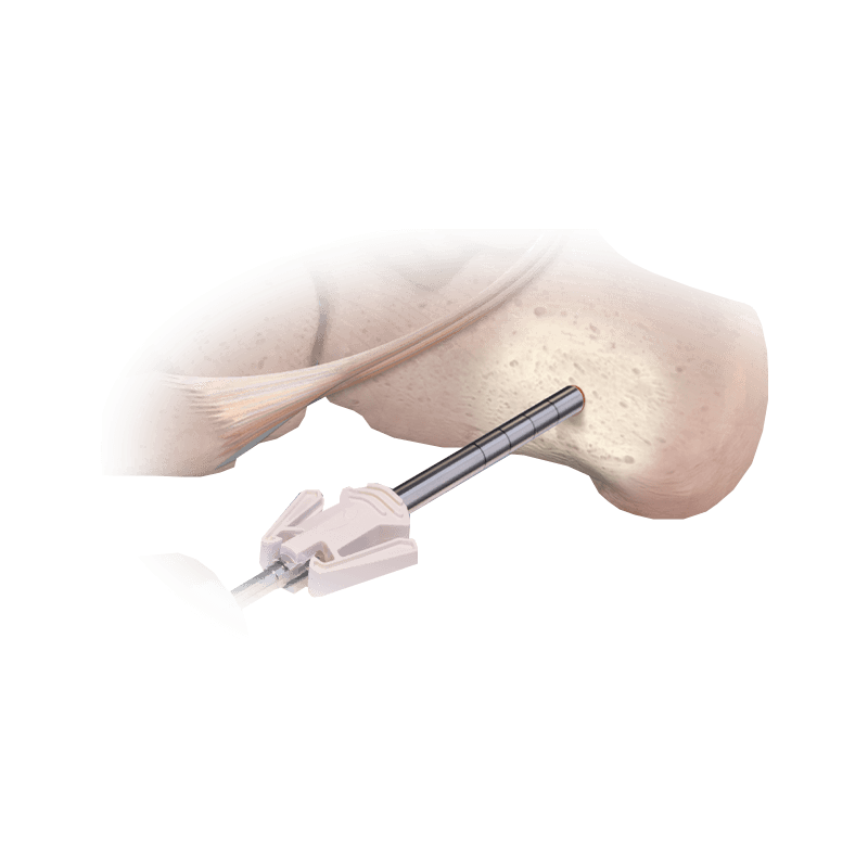 Recolector de injertos óseos CoLink<sup>®</sup>