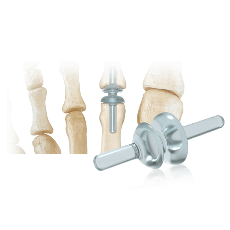 RTS® Lesser MTP