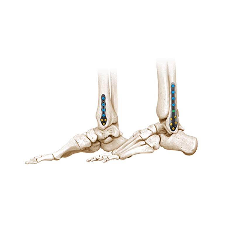CoLink® Afx Ankle Fracture Plating System